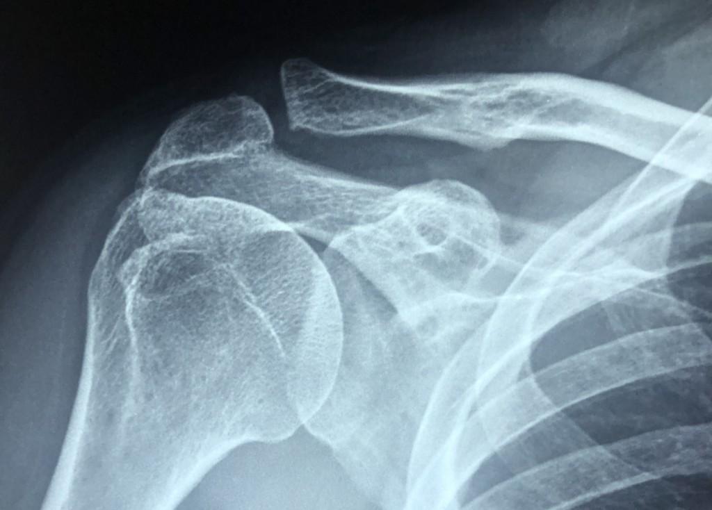 röntgenbild av en axel